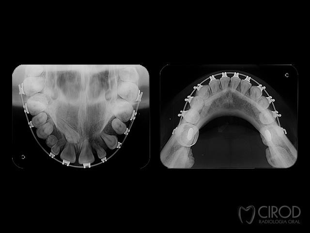 Oclusal