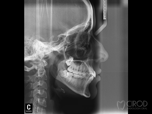 Cefalométrica de Perfil