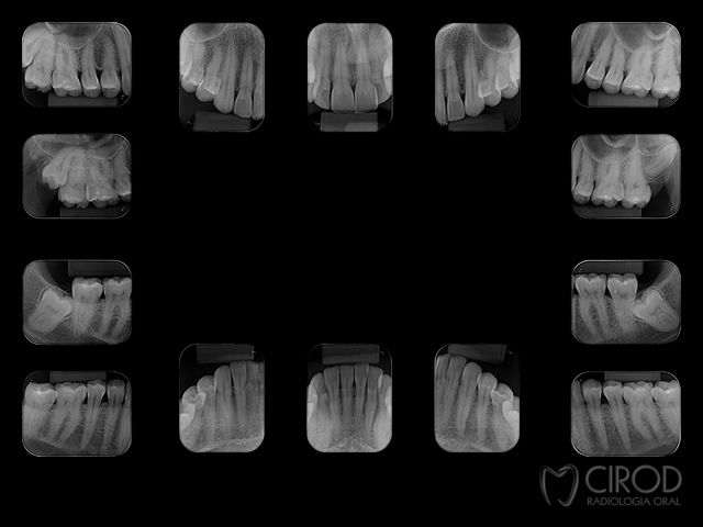 Periapical Completa