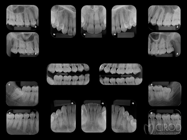 Periapical Completa com Interproximais