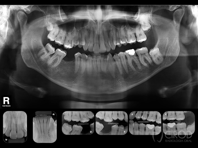 Panorâmica + Incisivos + Interproximais