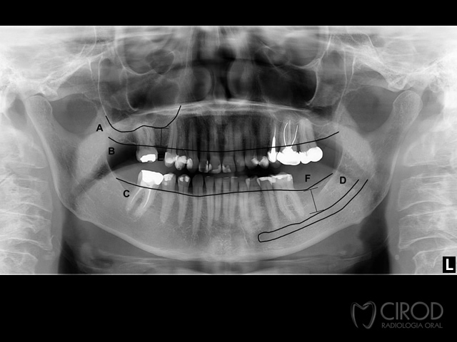 Panorâmica com Traçado p/ Implantes