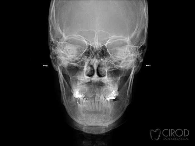 Cefalométrica Anteroposterior