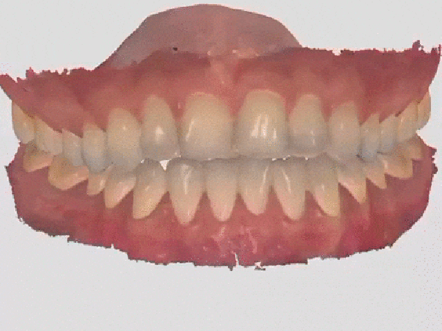Escaneamento intra-oral