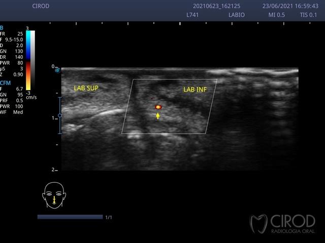 Ultrassonografia Doppler da Face